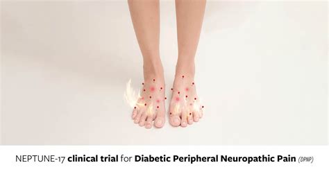 Join The Neptune 17 Clinical Trial For Diabetic Peripheral Neuropathic Pain Dpnp The