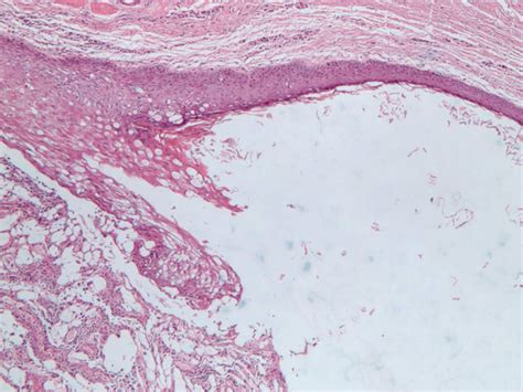 Dermoid Cyst With A Congenital Sinus Tract Over The Left Sternoclavicular Joint A Case Report