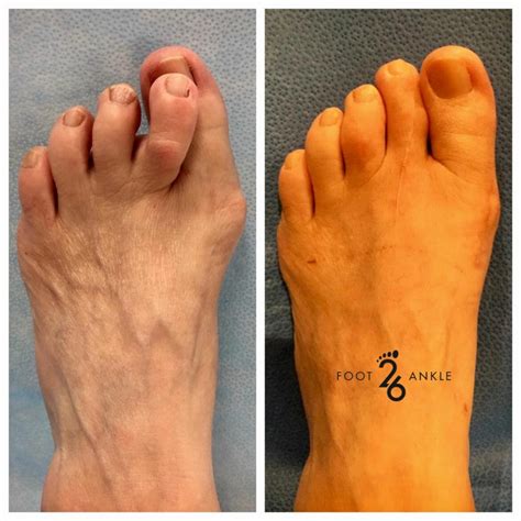 Hammertoe Surgery Cross Over Toe 26 Foot And Ankle