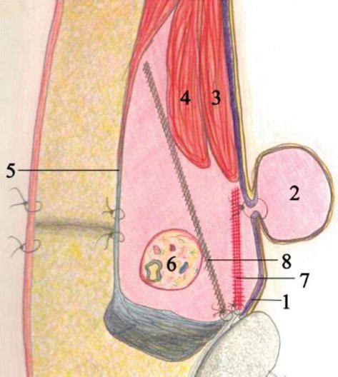 All In One Mesh Hernioplasty A New Procedure For Inguinal Hernia