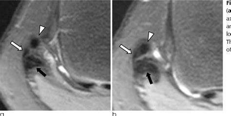 Biceps Femoris Tendon Mri