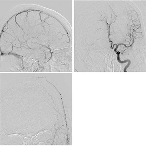 Cerebral Angiograms At Admission Showing No Vascular Abnormalities