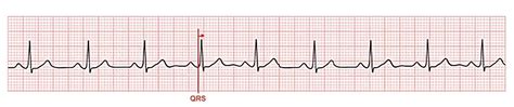 A Systematic Approach To Interpreting An Ecg Nursing Advanced Skills