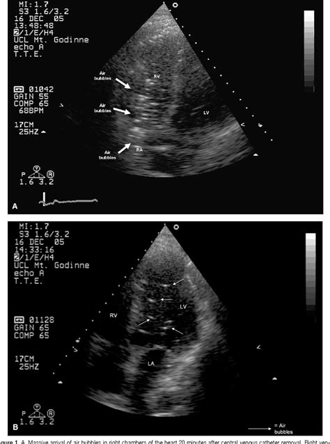 Figure 1 From Images In Cardiovascular Medicine Massive Air Embolism