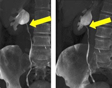 Zero to 64: CT urography zooms ahead with more detector rows | AuntMinnie