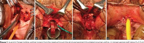 Figure 1 From Dorsal Onlay Graft Urethroplasty For Female Urethral