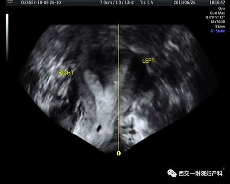 四维超声在妇科领域内的应用 三维
