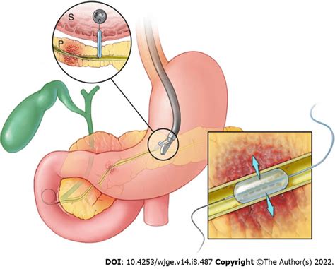 Illustration Of Endoscopic Ultrasound Guided Pancreatic Duct Access