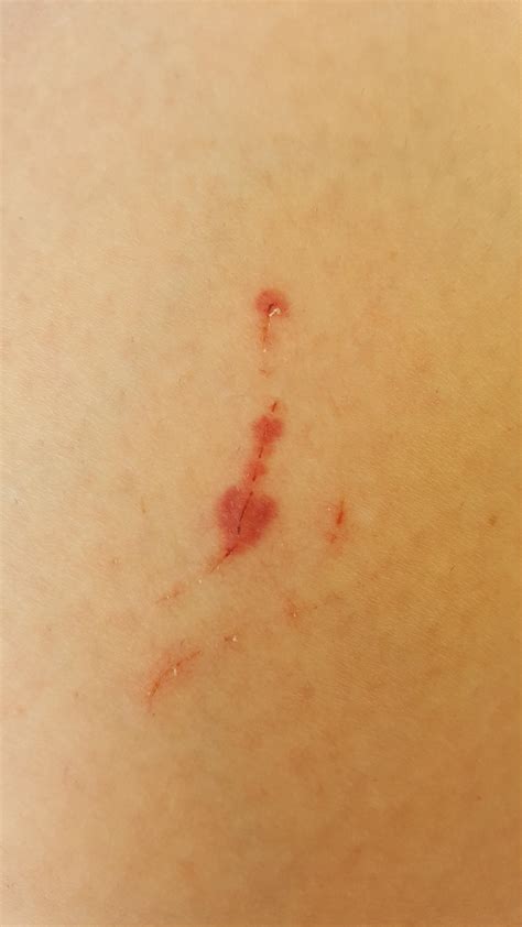 started bleeding   skin   time    smallest