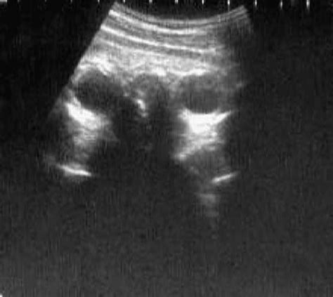 Intrapartum Ultrasound For The Diagnosis Of Cephalic Malpositions And Malpresentations