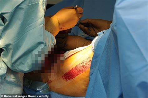 Top Canadian Surgeon Reveals TRUTH About Sex Change Ops Unearthed Video Lifts The Lid On Ill