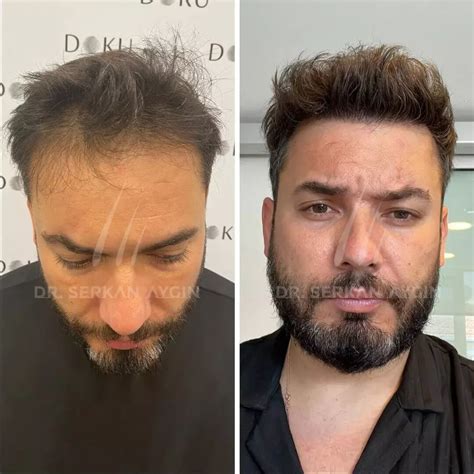 Dr Serkan Aygin İstanbul Top Hair Loss Clinic