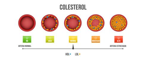 La Aterosclerosis Derivada Del Colesterol Alto Provoca El 85 De Las