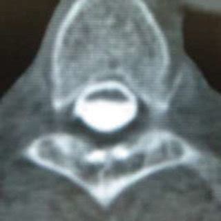 Preoperative T Weighted Mri And Ct Myelography A B Sagittal Mri