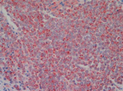 Dot Like Perinuclear Endostatin Immunostaining Within The Tumour Cells