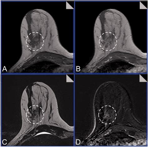 Motion Artifacts Lesion Type And Parenchymal Enhancement In Breast