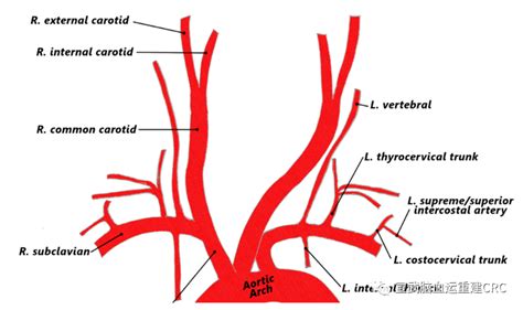Crc宣武之声｜锁骨下动脉盗血综合征血流循环症状