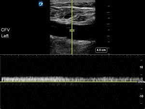 DVT – Why use Doppler? – Critical Care Sonography