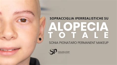 Come Ho Risolto Un Problema Di Alopecia Totale Su Un Ragazzo Di Anni