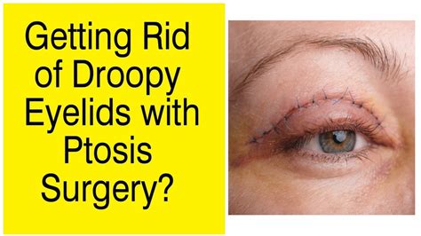 Fix Droopy Eyelids Ptosis Surgery The Esthetic Clinics India Youtube