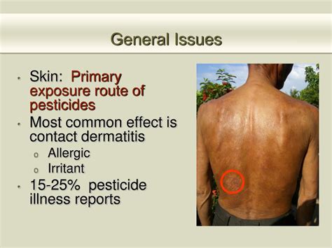 Ppt Acute Effects Of Pesticides On The Integumentary System