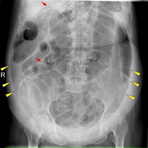 Massive Pneumoperitoneum After Colonoscopy Journal Of Emergency Medicine