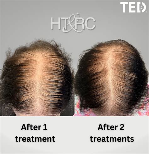 Alma Ted Hair Restoration For Women At Htandrc