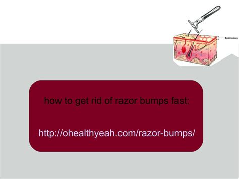 PPT This Is How To Get Rid Of Razor Bumps Fast PowerPoint