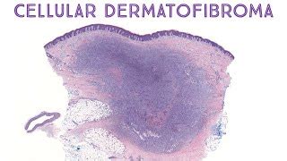 Dermatofibroma Histology