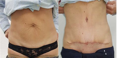 4 Inainte Si Dupa Before And After Abdominoplastie