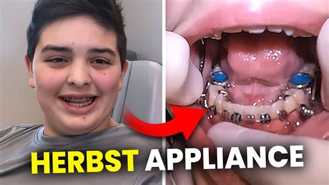 Getting A Herbst Appliance For An Overjet… [mckinney Orthodontist