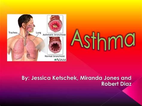 Ppt Asthma Powerpoint Presentation Free Download Id 2726643