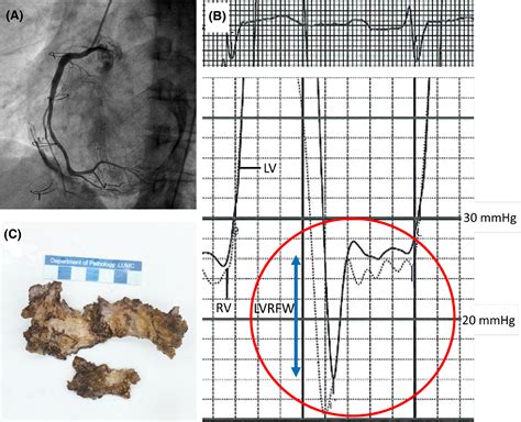 The Constrictive Consequences Of Pericardial Calcifications Egorova 2020 Clinical Case