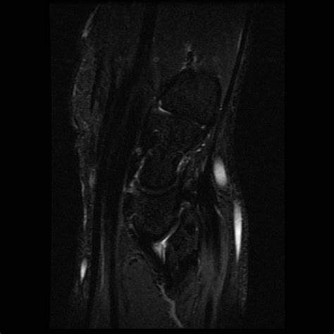 Madelung Deformity Image Radiopaedia Org