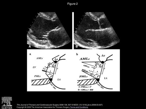 Insights On Left Ventricular And Valvular Mechanisms Of Recurrent