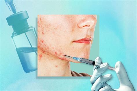 What To Expect When Getting Cortisone Shots For Acne