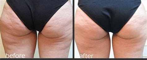 Cellulite Treatment Before And After Photos