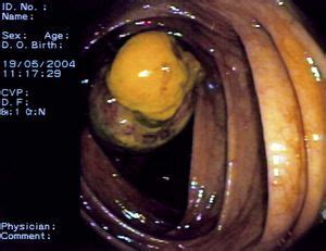 Invaginación ileocólica por un pólipo fibroide inflamatorio en un