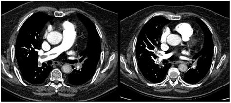 Axial Views Of Thoracic Contrast Enhanced Ct The Pte At The Right