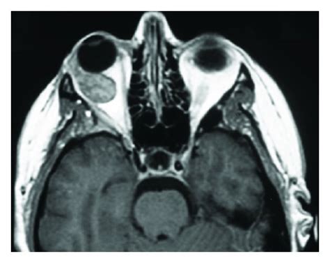 Magnetic Resonance Imaging Of A 49 Year Old Female 6 Weeks Prior To