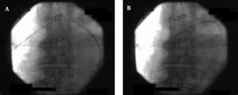 Intraoperative X Ray Fluoroscopy Images Download Scientific Diagram