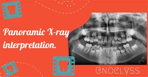 Panoramic X Ray Interpretation Interpretaci N De La Radiograf A