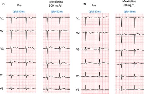 The Twelve Lead Ecg Of The Proband A And Sister B Administration