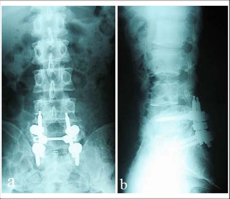 Two Year Follow Up Radiographs A Anteroposterior View And B Lateral Download Scientific