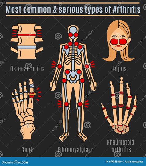 Arthritis Types Infographic Vector Illustration | CartoonDealer.com #159083460