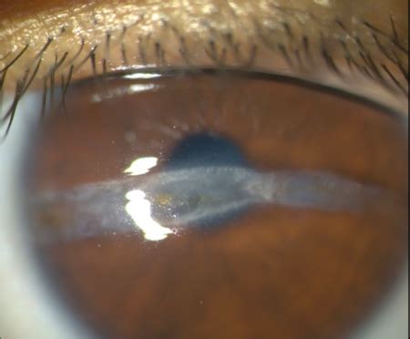 Linear Interstitial Keratitis - EyeWiki