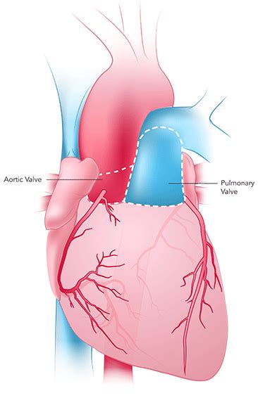 Enlarged Heart Cardiomegaly What It Is Symptoms Treatment Artofit