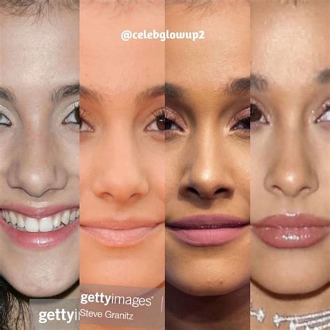 Ariana Grande Nose Job Nose Plastic Surgery Crooked Nose Rhinoplasty