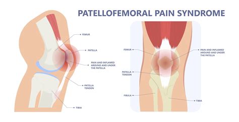 Patellofemoral Pain Syndrome PFPS SportsIn Orthopaedic Clinic Dr