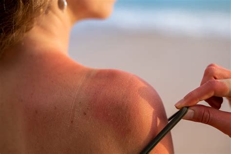 Understanding The Difference Sunburn Vs Sun Poisoning What You Need